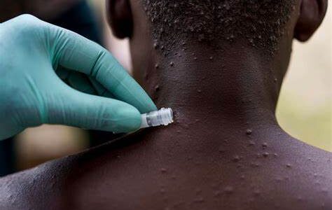 Centre holds meeting of experts on monkeypox