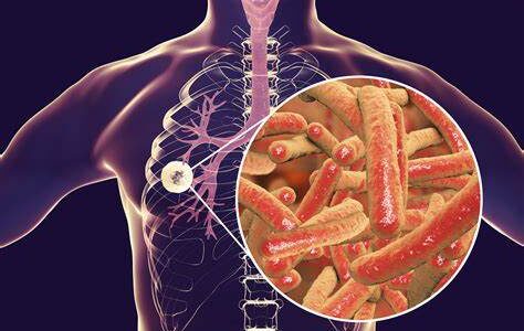 Anantnag, Pulwama declared Tuberculosis free, Srinagar gets gold Anantnag, Pulwama declared Tuberculosis free, Srinagar gets gold