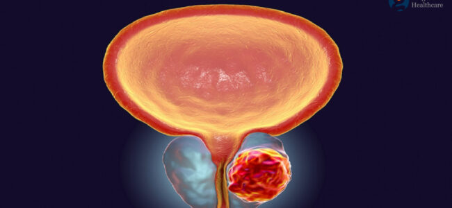 Prostate cancer cases to double between 2020 and 2040: Lancet Study