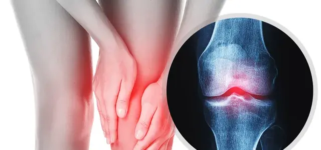 Nearly one billion people globally will have osteoarthritis by 2050: Lancet Study Nearly one billion people globally will have osteoarthritis by 2050: Lancet Study