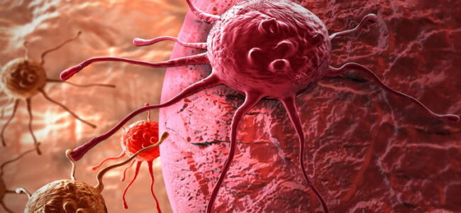 Rising incidence of cancer under-50s