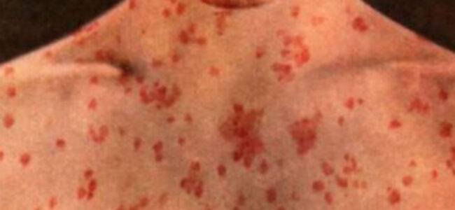 Why we’re still playing measles whack-a-mole