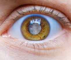 Glaucoma among leading causes of irreversible blindness: Experts Glaucoma among leading causes of irreversible blindness: Experts