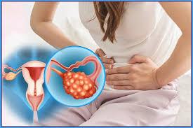 From PCOS to PMOS: Rethink on Women’s Health Condition From PCOS to PMOS: Rethink on Women’s Health Condition